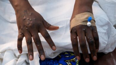 Manica: Em seguimento, cerca de 40 pessoas que tiveram contacto com pacientes infectados pelo mpox