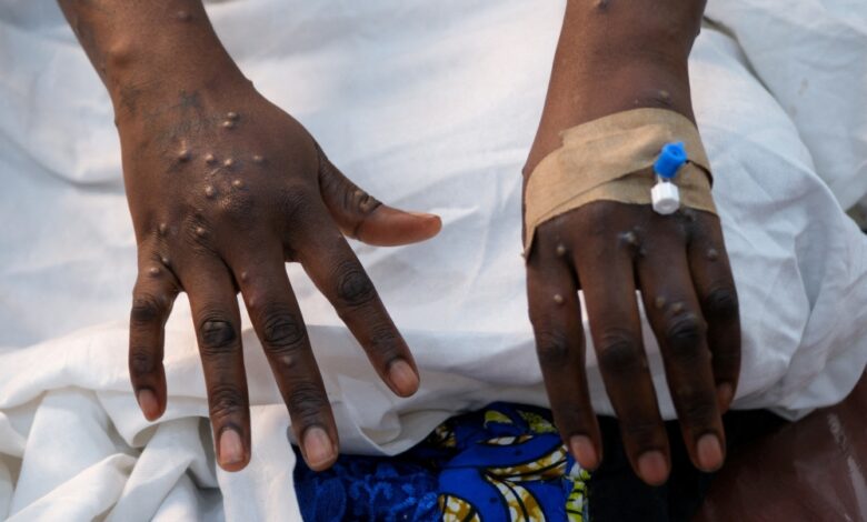 Manica: Em seguimento, cerca de 40 pessoas que tiveram contacto com pacientes infectados pelo mpox