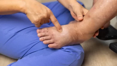 Inchaço desproporcional nas pernas. Será um lipedema ou linfedema?