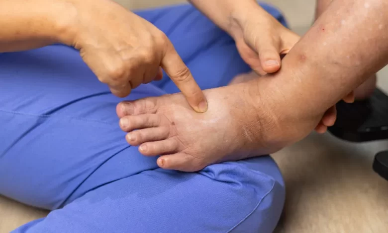 Inchaço desproporcional nas pernas. Será um lipedema ou linfedema?