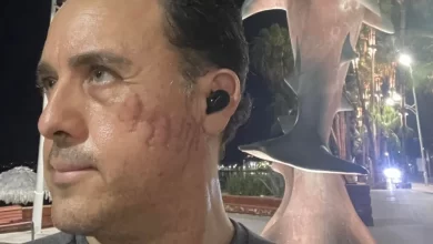 "Poupou-me a vida". Homem mordido na cabeça por tubarão na Costa Rica