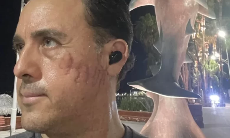 "Poupou-me a vida". Homem mordido na cabeça por tubarão na Costa Rica