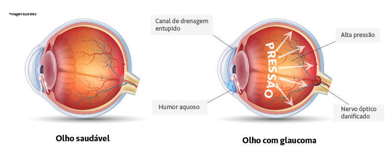 DIA MUNDIAL DO GLAUCOMA: Apenas dois especialistas para dez mil pacientes
